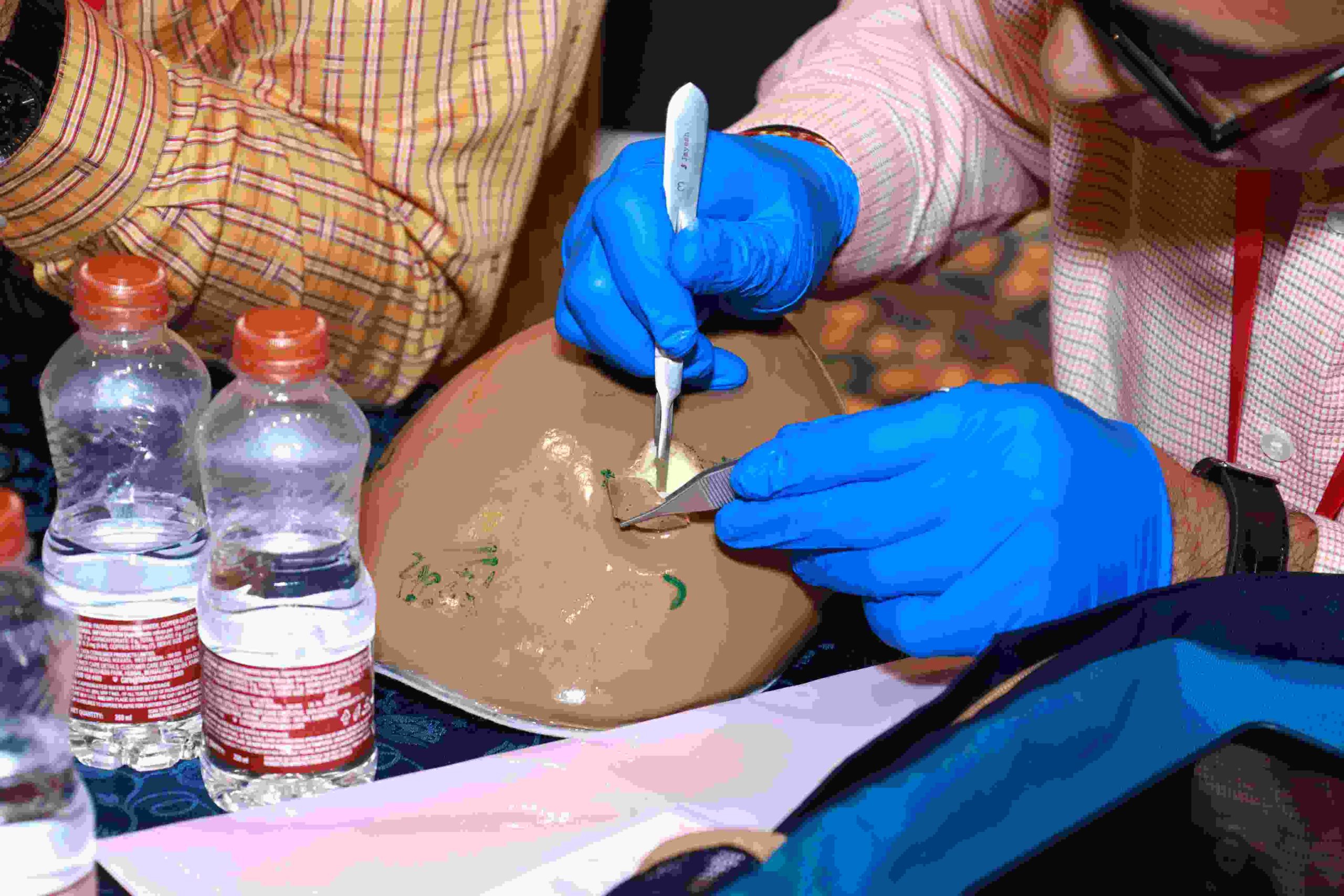 3rd Oncoplasty Breast Surgery Training Workshop 2026